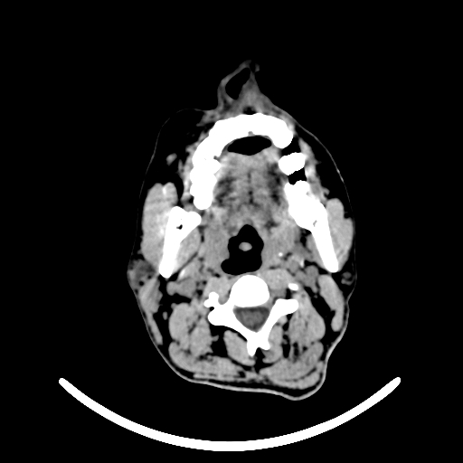 File:Chronic invasive fungal sinusitis with intraorbital and intracranial extension (Radiopaedia 56387-63046 Axial non-contrast 1).jpg