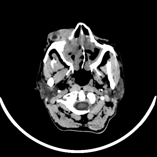 File:Chronic invasive fungal sinusitis with intraorbital and intracranial extension (Radiopaedia 56387-63046 Axial non-contrast 64).jpg