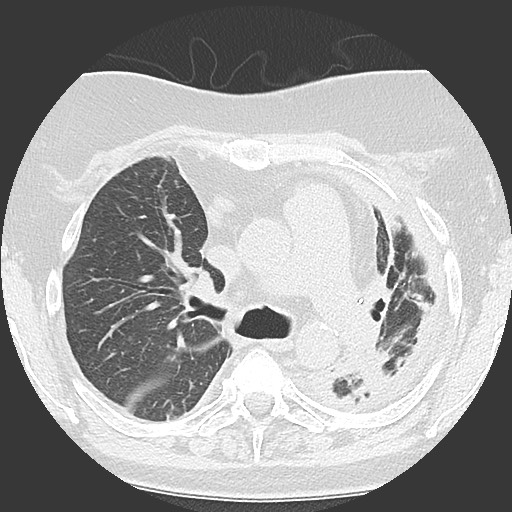 Chronic lung allograft dysfunction - restrictive form (Radiopaedia 60595-68316 Axial lung window 26).jpg