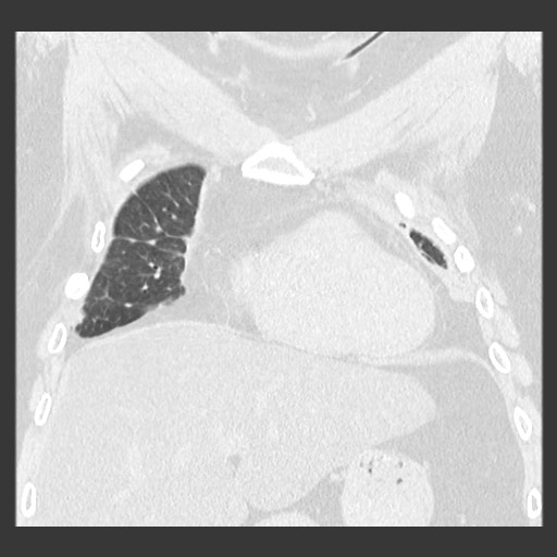 File:Chronic lung allograft dysfunction - restrictive form (Radiopaedia 60595-68316 Coronal lung window 35).jpg