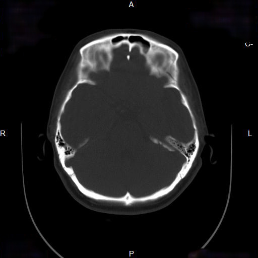 File:Chronic maxillary sinusitis with a foreign body (dental filling material) (Radiopaedia 7811-8639 Axial bone window 14).jpg