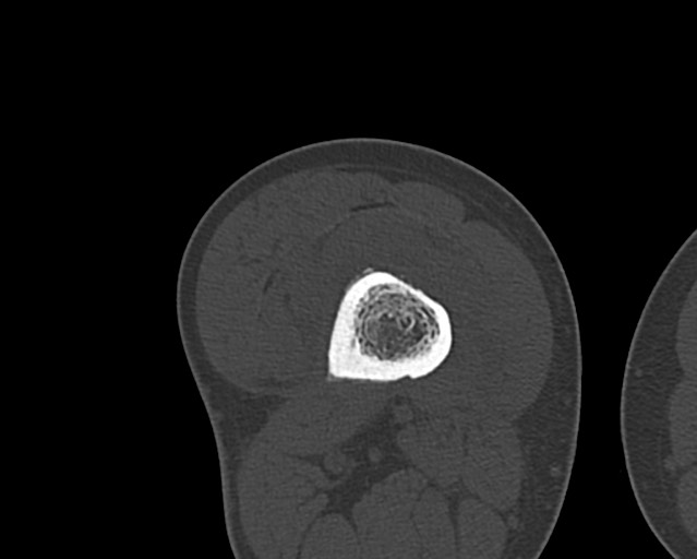 File:Chronic ostemyelitis of the femur with long sinus tract (Radiopaedia 74947-85982 Axial bone window 139).jpg