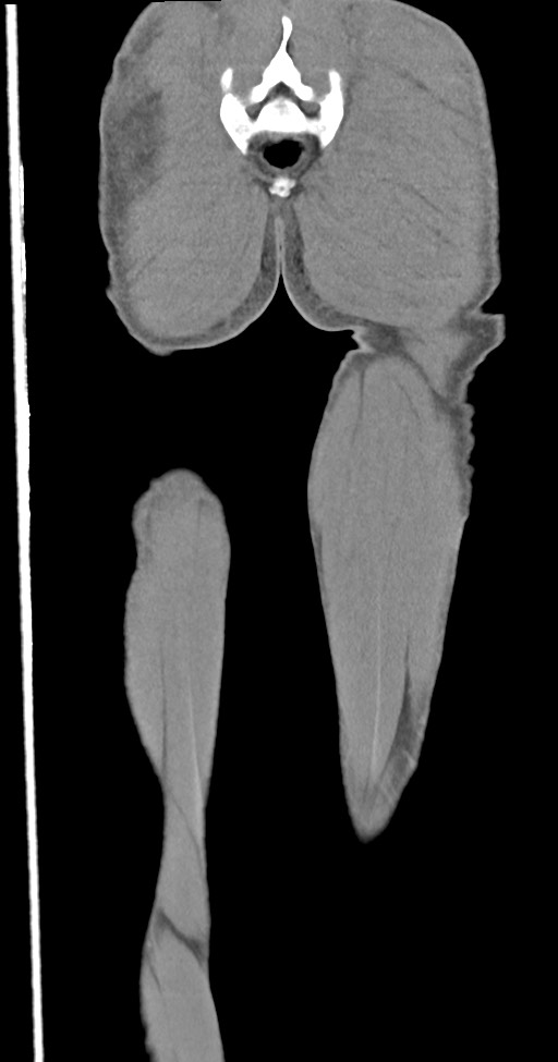 Chronic osteomyelitis (with sequestrum) (Radiopaedia 74813-85822 E 52).jpg