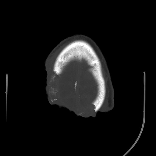 Chronic osteomyelitis - calvarial (severe) (Radiopaedia 69668-79616 Axial bone window 67).jpg