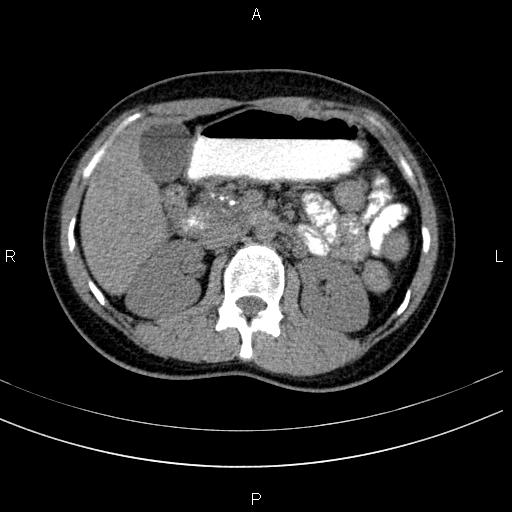 Chronic pancreatitis (Radiopaedia 64576-73450 Axial non-contrast 59).jpg