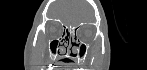 Chronic sphenoidal sinusitis (Radiopaedia 62030-70122 Coronal bone window 59).jpg
