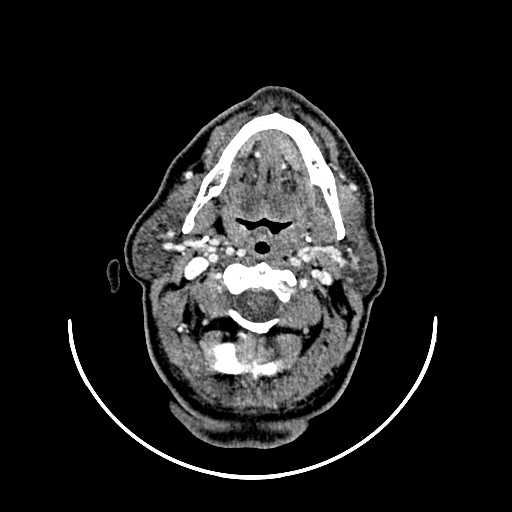 File:Chronic submandibular abscess (Radiopaedia 21738-21718 A 15).jpg