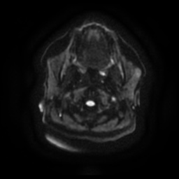 Chronic submandibular sialadenitis (Radiopaedia 61852-69885 Axial DWI 10).jpg