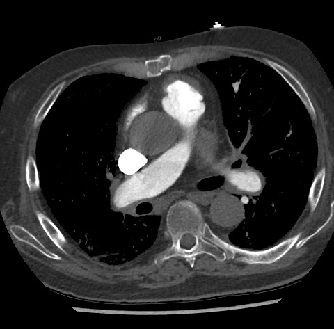 Chronic thromboembolic pulmonary disease (Radiopaedia 90694-108119 Axial C+ CTPA 48).jpg