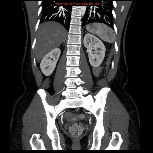 File:Circumaortic left renal vein (Radiopaedia 9069-9792 B 29).jpg