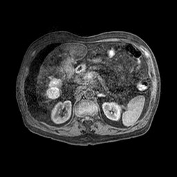 File:Cirrhosis and hepatocellular carcinoma in the setting of hemochromatosis (Radiopaedia 75394-86594 Axial T1 C+ fat sat 33).jpg