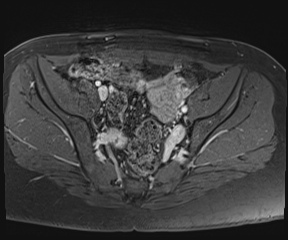 File:Class II Mullerian duct anomaly- unicornuate uterus with rudimentary horn and non-communicating cavity (Radiopaedia 39441-41755 Axial T1 fat sat 41).jpg