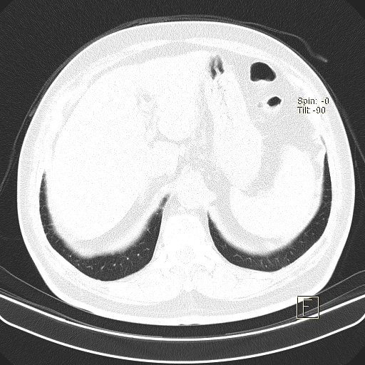 File:Classic complicated silicosis (Radiopaedia 49720-54961 Axial lung window 55).jpg