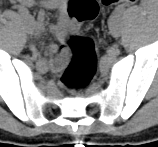 File:Clear cell meningoma - lumbar spine (Radiopaedia 60116-67691 Axial non-contrast 79).png