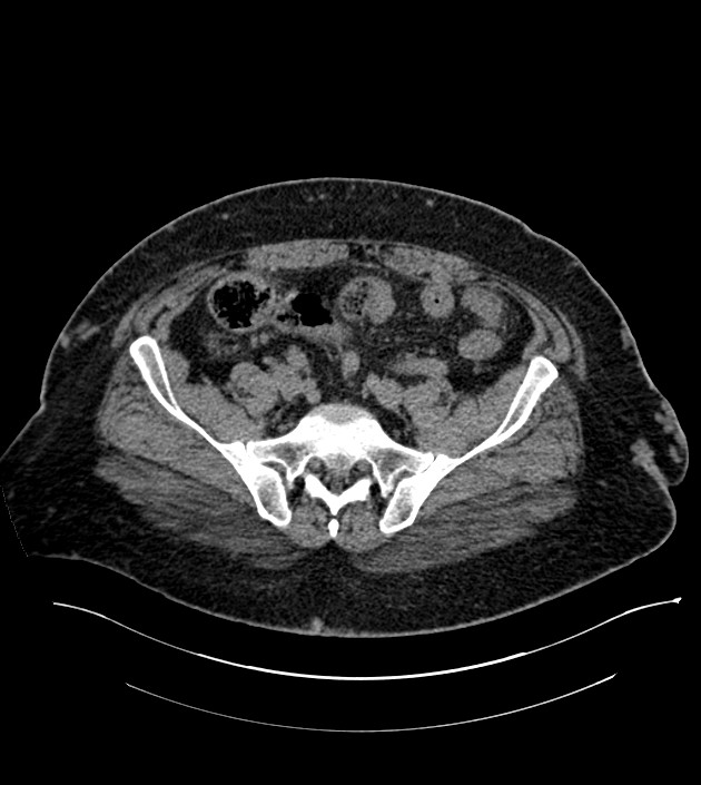 Closed-loop small bowel obstruction-internal hernia (Radiopaedia 78439-91096 Axial non-contrast 118).jpg
