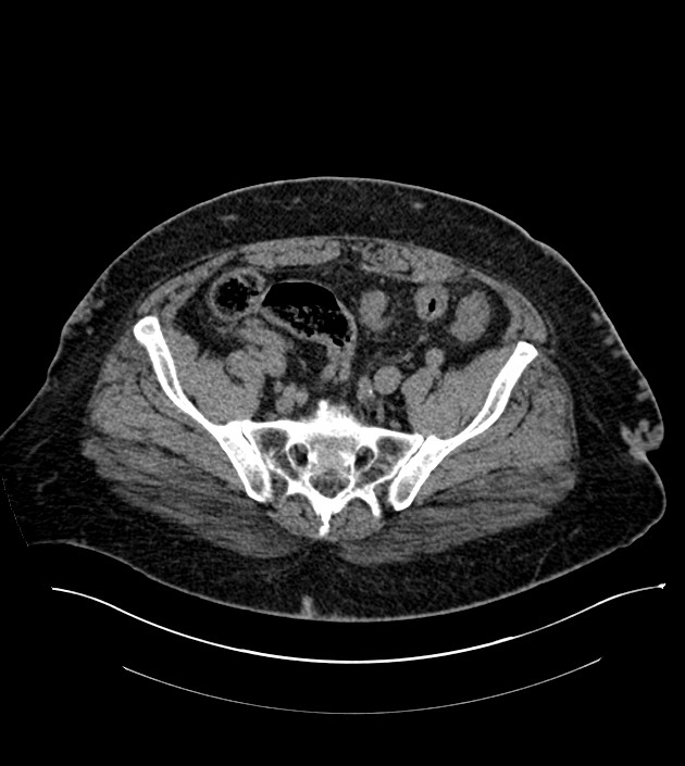 Closed-loop small bowel obstruction-internal hernia (Radiopaedia 78439-91096 Axial non-contrast 122).jpg