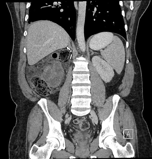 Closed loop obstruction - internal hernia into nephrectomy bed (Radiopaedia 59867-67320 B 91).jpg