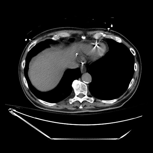 File:Closed loop obstruction due to adhesive band, resulting in small bowel ischemia and resection (Radiopaedia 83835-99023 Axial non-contrast 21).jpg