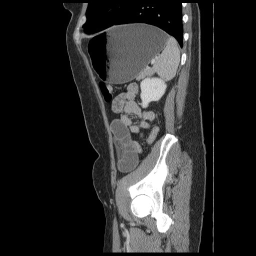 Closed loop small bowel obstruction (Radiopaedia 65403-74451 C 84).jpg