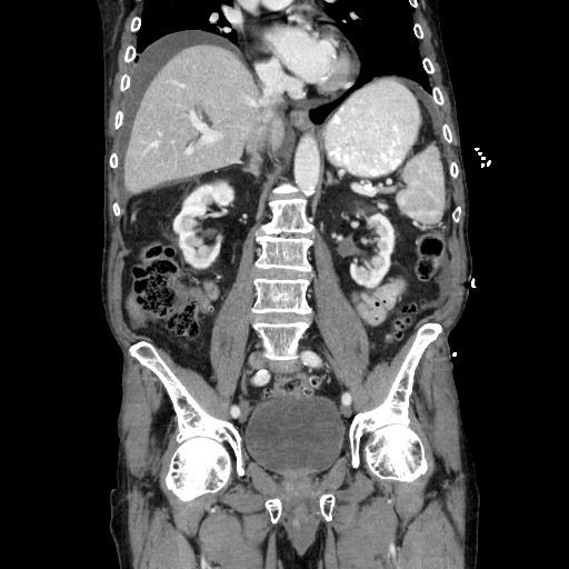 Closed loop small bowel obstruction - adhesive disease and hemorrhagic ischemia (Radiopaedia 86831-102990 B 73).jpg