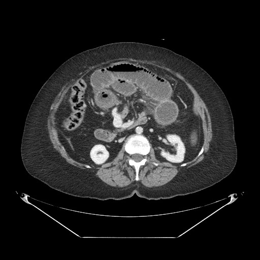 Closed loop small bowel obstruction - internal hernia (Radiopaedia 65402-74450 A 55).jpg