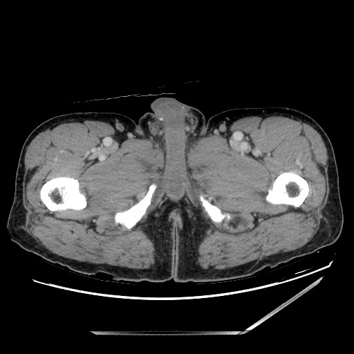 Closed loop small bowel obstruction - omental adhesion causing "internal hernia" (Radiopaedia 85129-100682 A 190).jpg