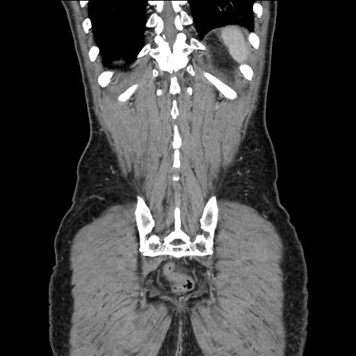Closed loop small bowel obstruction - omental adhesion causing "internal hernia" (Radiopaedia 85129-100682 B 110).jpg