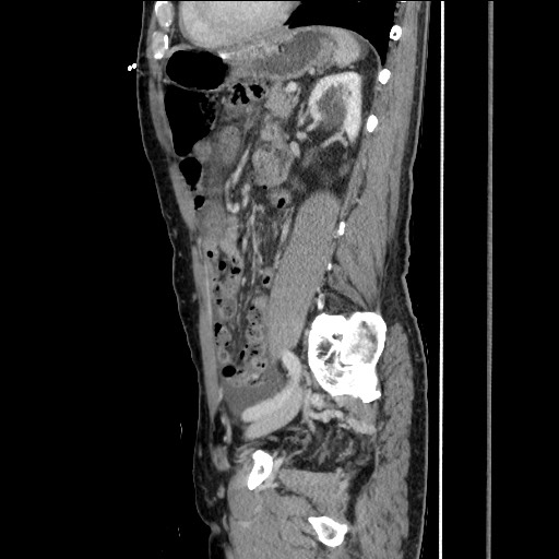 Closed loop small bowel obstruction - omental adhesion causing "internal hernia" (Radiopaedia 85129-100682 C 118).jpg