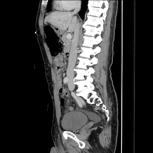 File:Closed loop small bowel obstruction - omental adhesion causing "internal hernia" (Radiopaedia 85129-100682 C 86).jpg