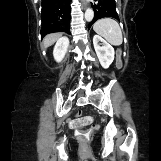 Closed loop small bowel obstruction due to adhesive band, with intramural hemorrhage and ischemia (Radiopaedia 83831-99017 C 91).jpg