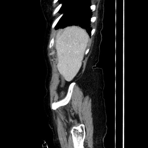 Closed loop small bowel obstruction due to adhesive band, with intramural hemorrhage and ischemia (Radiopaedia 83831-99017 D 47).jpg