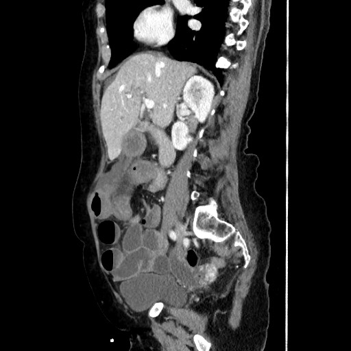 Closed loop small bowel obstruction due to adhesive band, with intramural hemorrhage and ischemia (Radiopaedia 83831-99017 D 85).jpg
