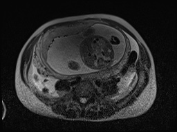Closed loop small bowel obstruction in pregnancy (MRI) (Radiopaedia 87637-104031 D 12).jpg