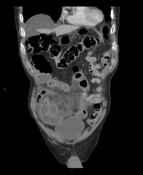 File:Closed loop small bowel obstruction with ischemia (Radiopaedia 84180-99456 B 53).jpg