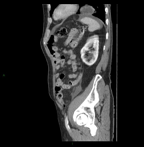 Closed loop small bowel obstruction with ischemia (Radiopaedia 84180-99456 C 70).jpg
