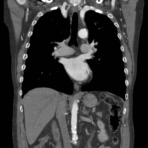 File:Coarctation of the aorta (Radiopaedia 17427-17116 A 44).jpg