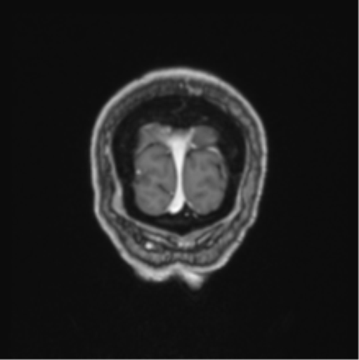 Colloid cyst of the third ventricle (Radiopaedia 86571-102662 Coronal T1 C+ 8).png