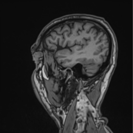 File:Colloid cyst of the third ventricle (Radiopaedia 86571-102662 Sagittal T1 16).png