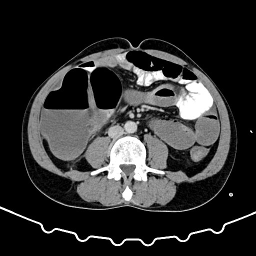 File:Colocolic intussusception due to large lipoma (Radiopaedia 68773-78482 Axial 106).jpg