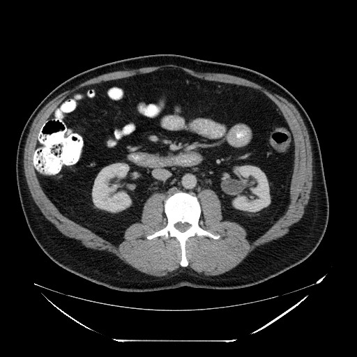 Colocolic intussusception due to lipoma (Radiopaedia 73712-84508 A 52).jpg