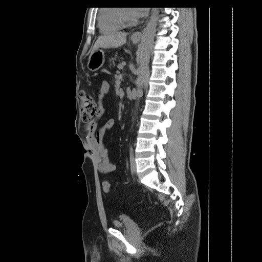 File:Colocutaneous fistula in Crohn's disease (Radiopaedia 29586-30093 C 29).jpg