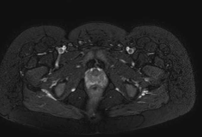 Colon adenocarcinoma with Krukenberg tumors, advanced pregnancy (Radiopaedia 67279-76645 Axial T2 SPAIR 2).jpg