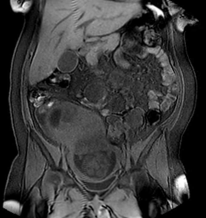 Colon adenocarcinoma with Krukenberg tumors, advanced pregnancy (Radiopaedia 67279-76645 E 39).jpg