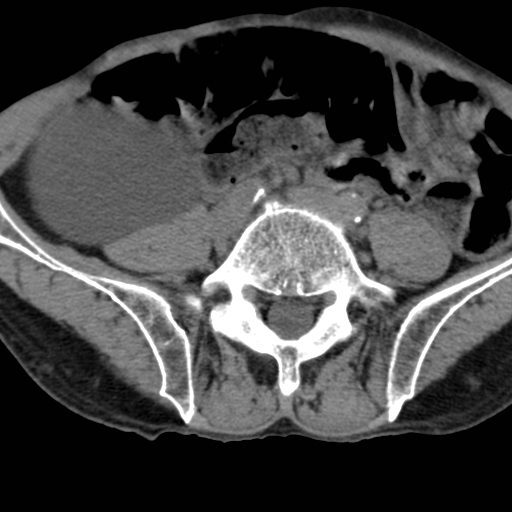 Colon cancer with calcified liver metastasis (Radiopaedia 74423-85309 Axial non-contrast 74).jpg