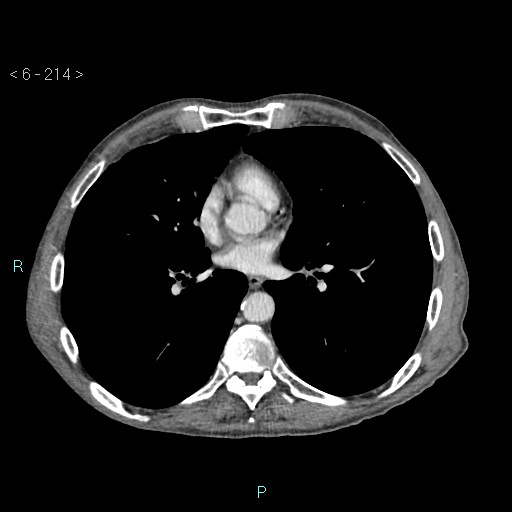 Colonic cancer (ultrasound and TC imaging) (Radiopaedia 50346-55713 B 214).jpg