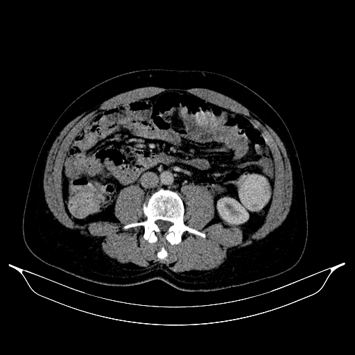Colonic diverticulosis (Radiopaedia 72222-82744 A 29).jpg