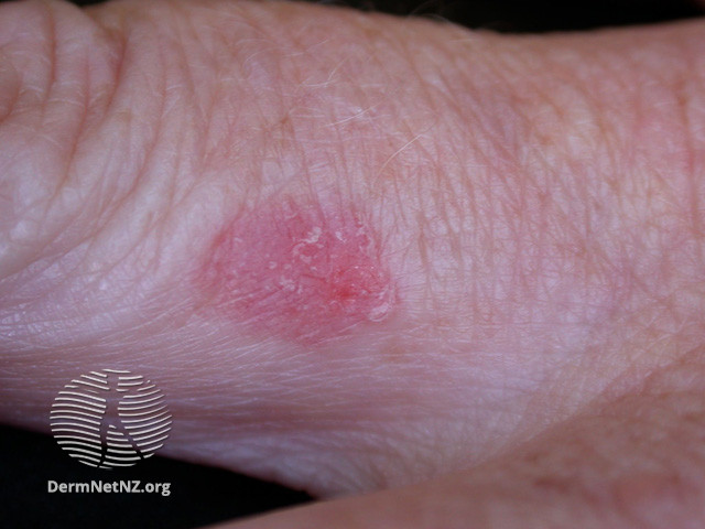 Intraepidermal carcinoma (DermNet NZ lesions-scc-in-situ-2953).jpg