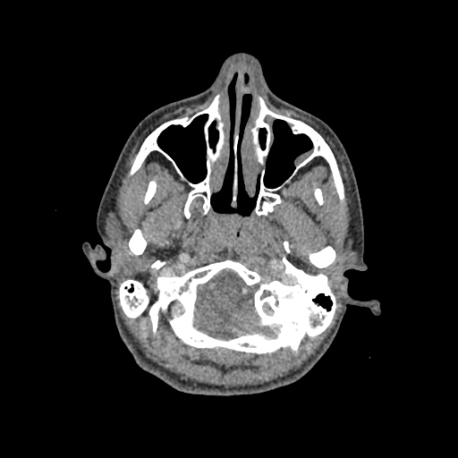 File:Nasal pyogenic granuloma (lobular capillary hemangioma) (Radiopaedia 85536-101244 C 51).jpg