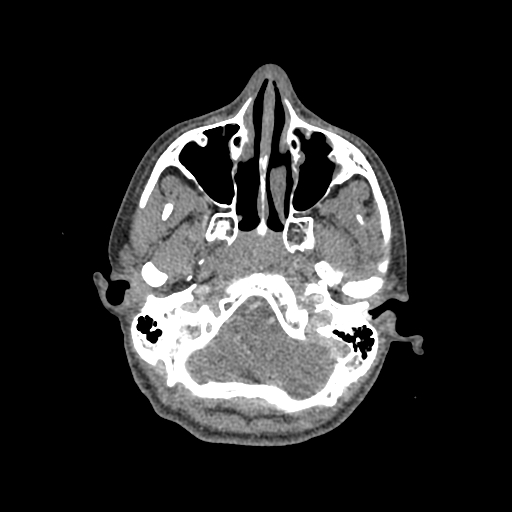 File:Nasal pyogenic granuloma (lobular capillary hemangioma) (Radiopaedia 85536-101244 C 66).jpg