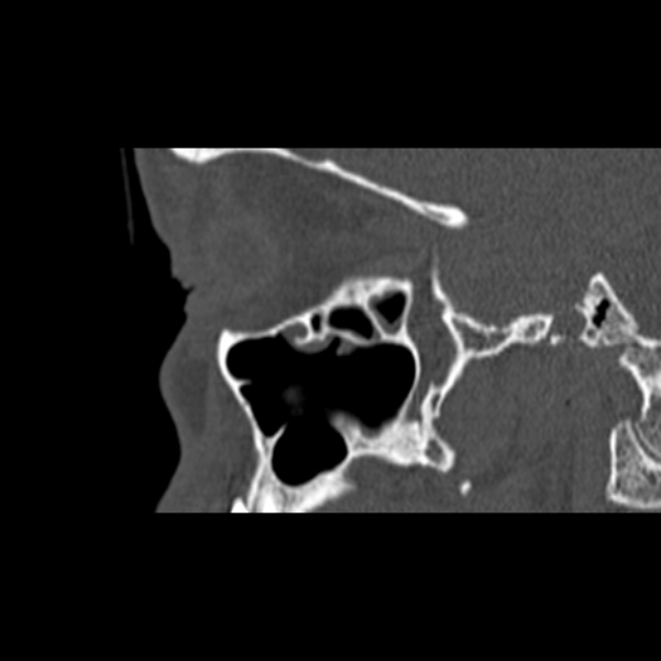 Nasal septal perforation (Radiopaedia 25030-25289 Sagittal bone window 53).jpg